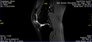 MRI von meinem Knie - Startup-Learnings von meinem Marathon